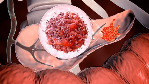 Adenokarcinom pankreasa i neuroendokrini tumor pankreasa kao vrste Vrste raka pankreasa - adenokarcinom i neuroendokrini tumor