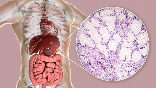 Adenokarcinom Adenokarcinom lečenje