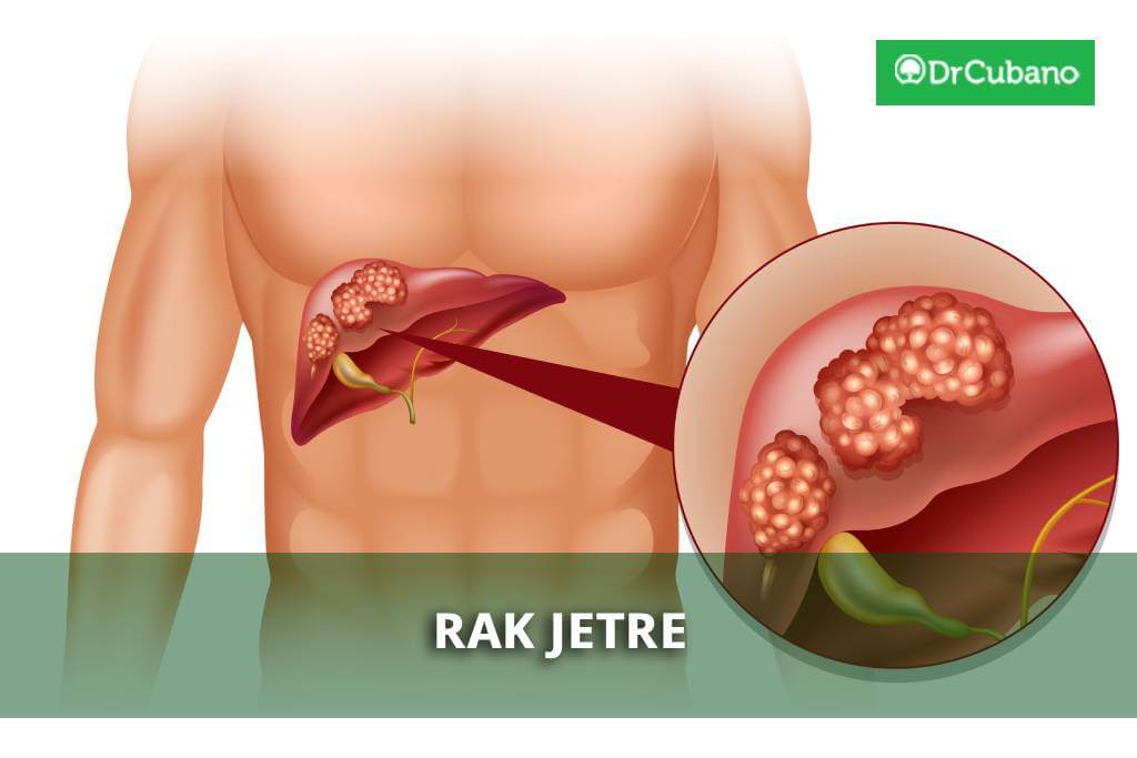 Karcinom jetre