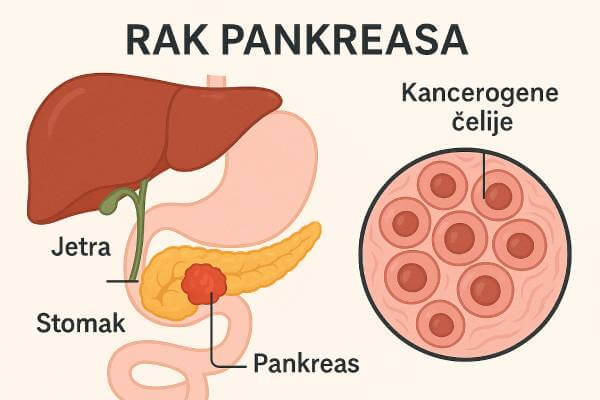 Rak gušterače - značenje Definicija kancera pankreasa